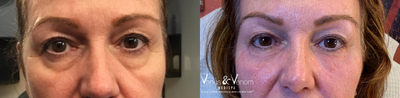 Restylane before and after photo