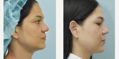 Rhinoplasty before and after photo