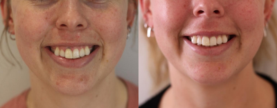 Botox for Gummy Smile before and after photo
