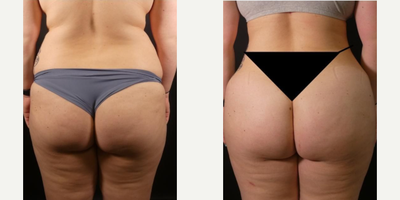 Brazilian Butt Lift before and after photo