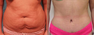 Diastasis Recti Repair before and after photo