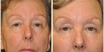 Eyelid Surgery before and after photo