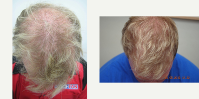 Hair Transplant before and after photo