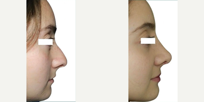 Rhinoplasty before and after photo