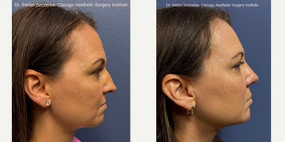 Rhinoplasty before and after photo
