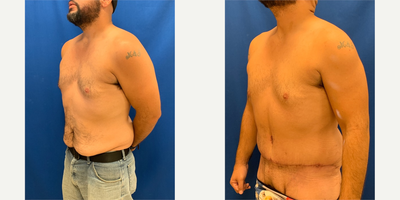 Tummy Tuck before and after photo