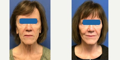 Facelift before and after photo