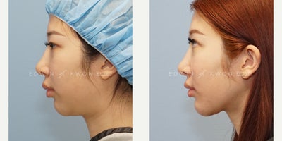Liposuction before and after photo