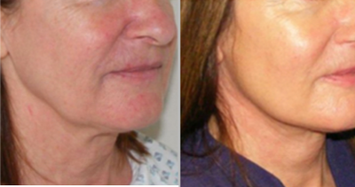 Neck Lift before and after photo