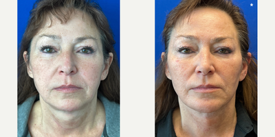 Chin Implant before and after photo