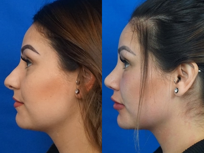 Eyelid Surgery before and after photo