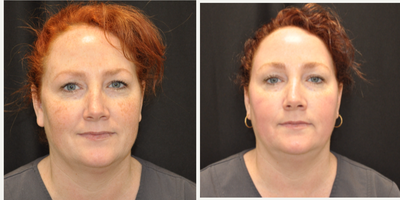Halo Laser before and after photo