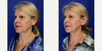 Profound RF before and after photo