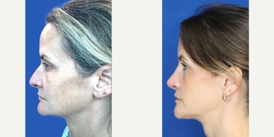 Rhinoplasty before and after photo