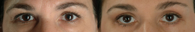 Botox before and after photo