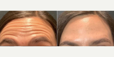 Botox before and after photo