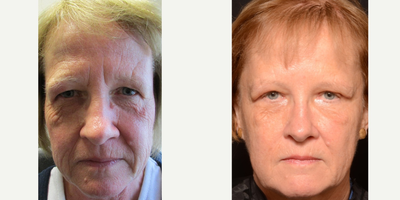 Brow Lift before and after photo