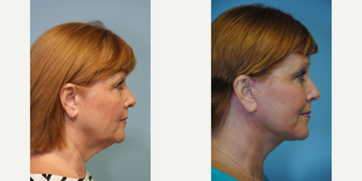 Facelift before and after photo