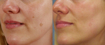 IPL before and after photo
