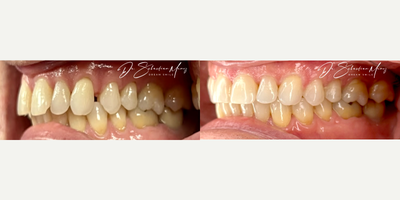Invisalign before and after photo