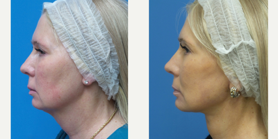 Neck Lift before and after photo