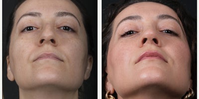 Rhinoplasty before and after photo