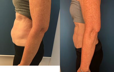 truSculpt before and after photo