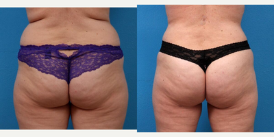 Liposuction before and after photo