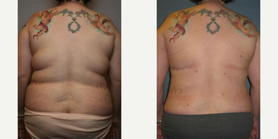 Liposuction before and after photo
