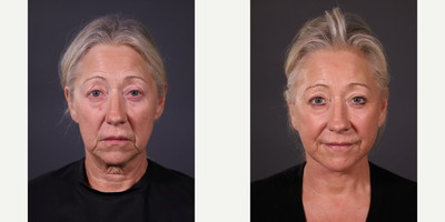 Neck Lift before and after photo