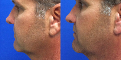 Nonsurgical Facelift before and after photo