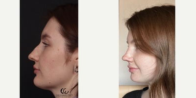 Rhinoplasty before and after photo