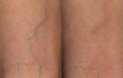 Sclerotherapy before and after photo