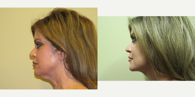 Smart Lipo before and after photo