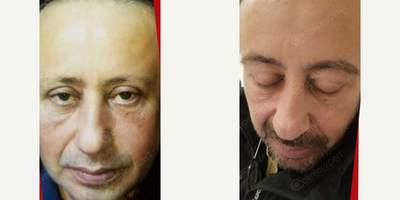 Eyebrow Transplant before and after photo