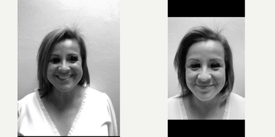 Thread Lift before and after photo