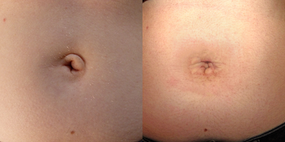 Belly Button Surgery before and after photo
