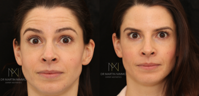 Botox before and after photo