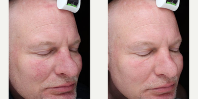 BroadBand Light (BBL) before and after photo
