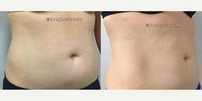 CoolSculpting before and after photo
