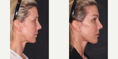 Neck Lift before and after photo