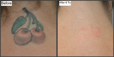 PicoSure before and after photo