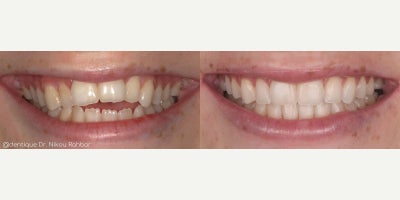 Teeth Whitening before and after photo