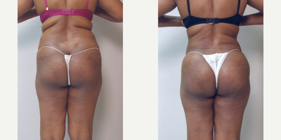 Butt Augmentation before and after photo