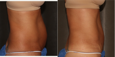 CoolSculpting before and after photo