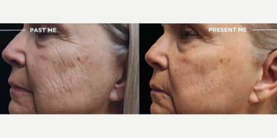 Emface before and after photo