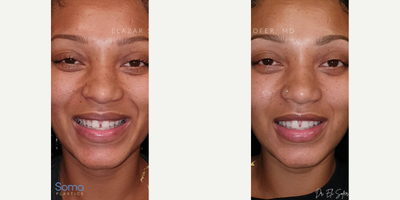 Lip Fillers before and after photo