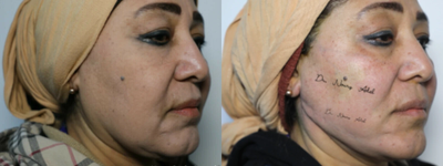 NovaThreads before and after photo