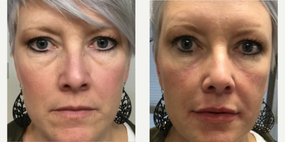 Volbella before and after photo