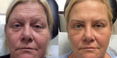 Botox before and after photo